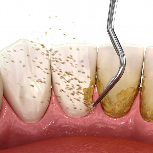 Scaling of teeth with ultrasonic scaler