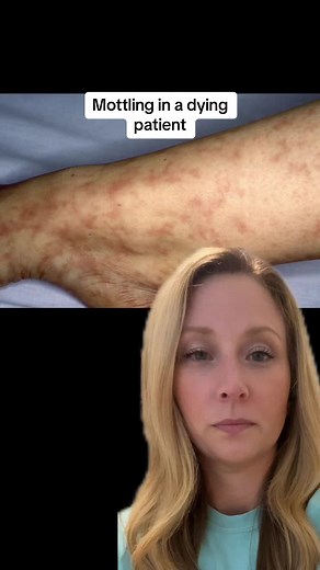 When we see mottling in our hospice patients we know the end is near. With that being said people can have mottling for other reasons and it does not mean that they are dying. #hospicenursing #mottling