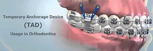 Temporary Anchorage Device (TAD) Usage in Orthodontics (with video) | Vancouver Orthodontic Specialists, PLLC