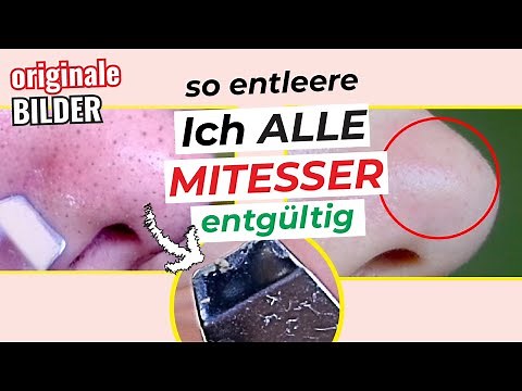 🚫👃 Mit dieser Methode Mitesser KOMPLETT entfernen! - Einfacher gehts nicht! - Mitesser loswerden
