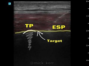 Errector spinae block and catheter