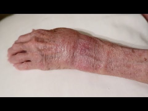 Broken Wrist Recovery After Surgery And Cast Removal