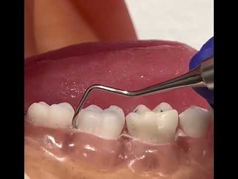 Posterior Sickle Scaler S204S