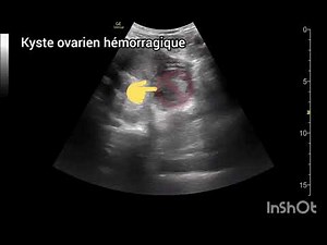 Kyste ovarien hémorragique Échographie