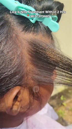 Jasmin J | Lice & Nits Treatment With in 2Hrs🫣🙄 ... ... ... ... ... #hair #trending #foryou #hairstyle #headlice | Instagram