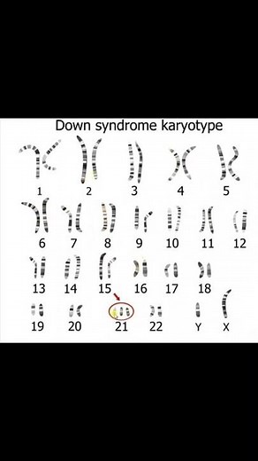 Downs syndrome Karyotype