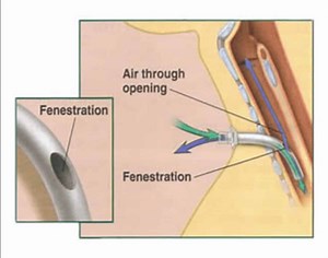 Fenestrated Vs Unfenestrated Tracheostomy | Tracheostomy Education