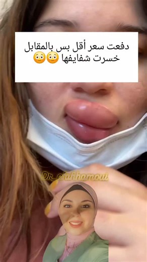 Dr Afaf Hamoui on Instagram‎: "كتير ناس بيعملو فيلر بوقت العروضات بمواد رخيصة، وبيفكرو انه “شو المشكلة؟ مجرد حقنة” لكن الحقيقة إنه الحقن الخاطئ أو المادة الملوّثة ممكن تسبب التهاب شديد وانسداد بالأوعية الدموية بالتالي نقص تروية للانسجة فالنتيجة هي تعفّن وغرغرينا بالشفاه (موت جزء من الشفة) الأعراض الاولى بتكون تورم شديد وألم وحرارة بس لما صار انسداد بالشريان الأنسجة ما وصلها دم وتحوّل الالتهاب لغرغرينا خلال ساعات سلامتكم أهم من أي عروضات أو سعر رخيص اختارو طبيب مختص مو خصم مغري 👇 شو رأيكم؟ قد سم