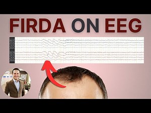 FIRDA on EEG: What It Means and Its Clinical Associations
