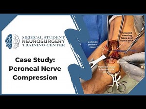 Case Study: Peroneal Nerve Compression