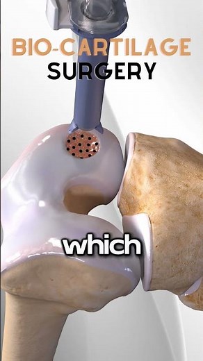 How Knee Cartilage surgery performed? | Medanime With Dr.Ramkrizz