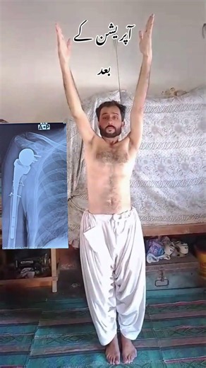 Reverse shoulder replacement recovery #dryasirkhan #ykorthopaedics #shoulder #shoulderpain