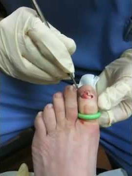 Performing a Total Nail Avulsion