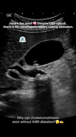 “Gallbladder Stones with CBD Stones — Cholelithiasis & Choledocholithiasis on Ultrasound” #CBDStone