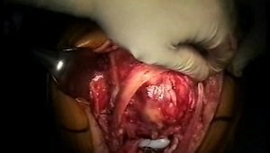 Extensor Mechanism Repair in Total Knee Arthroplasty (No Audio)