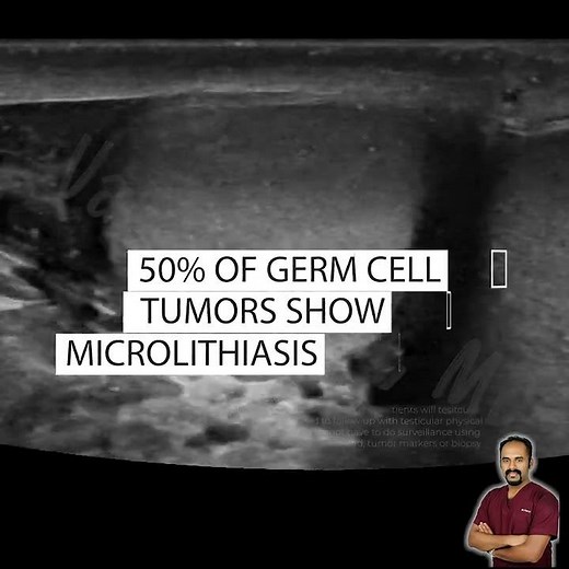 Testicular microlithiasis. Should we worry?