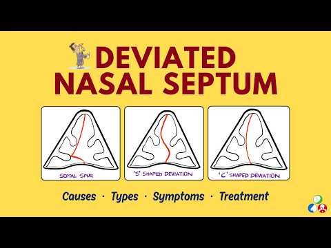 Deviated Nasal Septum (DNS) | Causes, Types, Symptoms, Treatment