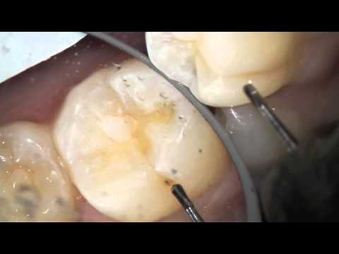 Seldom done by dentists: MIRROR used to remove Buccal decay on lower molars