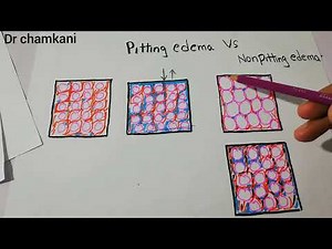 Renal physiology 30 | Pathophysiology of Pitting edema | Nonpitting edema | @Drchamkani