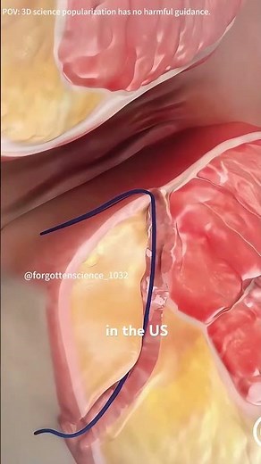 Pilonidal cyst treatment!!(3D animation) #theflash #smiledesigndental #3danimation #doctor #anatomy