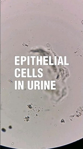 Epithelial cells in urine under the microscope #laboratory #medtechstudent #mls #cls #urinesediment