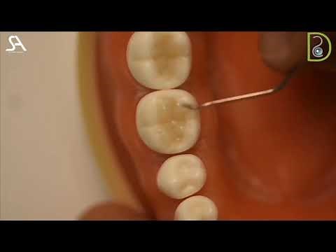 Dentiscope | Class I Composite Restoration Bulk fill technique