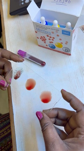 BLOOD GROUPING #pathology #bloodgroup