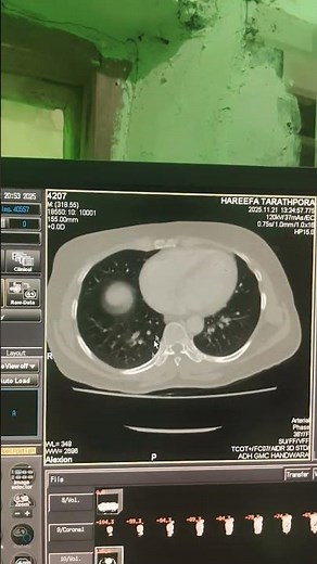 HECT CHEST | high resolution ct scan of chest axial planes |Toshiba 16 slice modelity