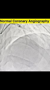 Normal Coronary Angiography #heartattack #heartattackprevention #heart #hearthealth #hearttreatment #health #health #healthcare #healthtips #cardio #cardioworkout #CardiacCare #cardiacrehabilitation #cardiovascular #treatment #disease #medicine #reel #reelsviral #reelsvideo #fbreelsvideo #explore #explorepage | Sonu Sharma