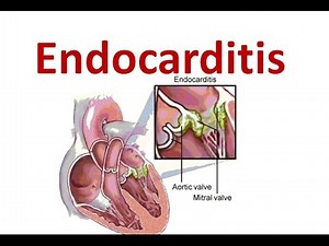 Endocarditis