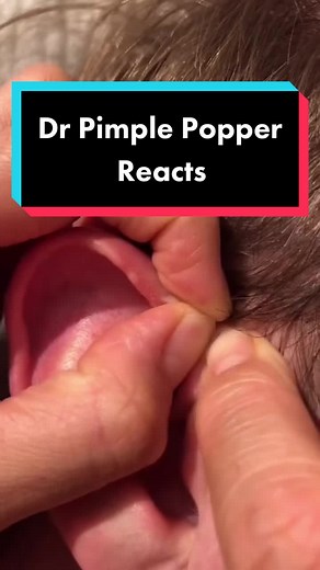 Understanding Preauricular Sinus and Ear Pits