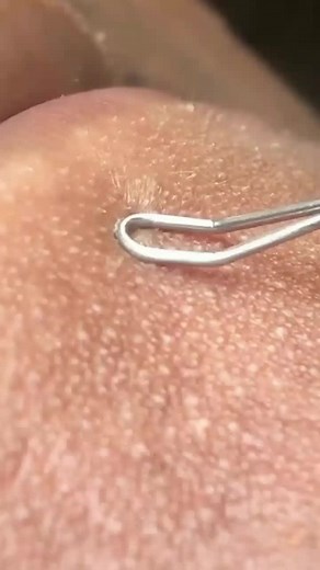 #pimplepopper2022 #satisfying #cystpopping #skincare #removal #acne #pimplepopping #pimplepopper2021 #pimplepopper #pimples #pimplepop #pimple #tiktok #fyp