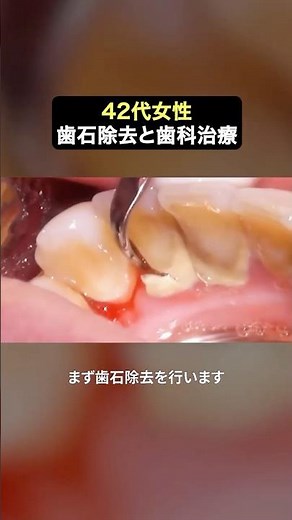 歯石除去も抜歯も恐れなくて大丈夫‼️#ザホワイトデンタルクリニック #歯医者 #歯石除去 #抜歯