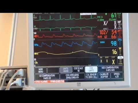 Capnostat ETCO2 calibration and application