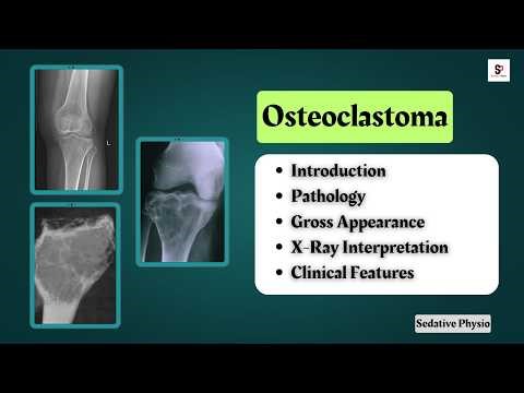 Osteoclastoma (Giant Cell Tumor) - Pathology & X-ray Interpretation | Sedative Physio