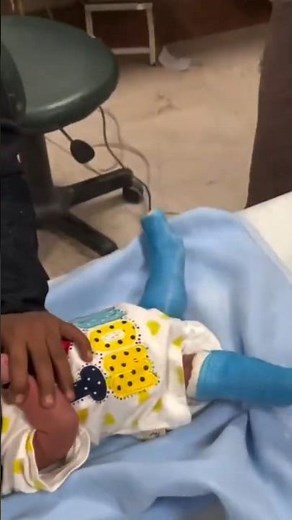 Serial casting removal 🦵 Step towards mobility & confidence! #Prosthetics #Orthotics #Rehab #Casting