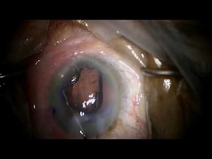 Simplified Technique for Removing a Malyugin Ring