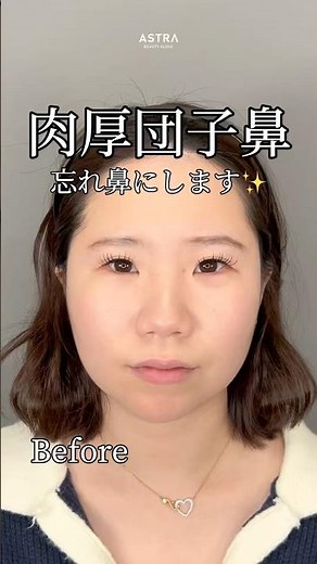 [Transforming a thick, fleshy nose into a "forgettable nose" 👀‼️ #forgettablenose #nosesurgery #K...