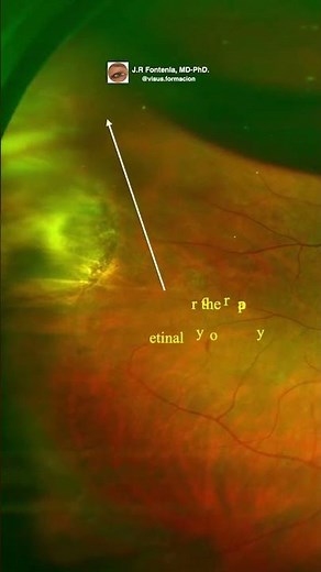 Pneumatic retinopexy. Transconjunctival cryopexy. Retinal detachment.