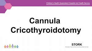 Cannula Cricothyroidotomy