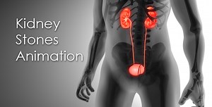 Kidney Stones Animation