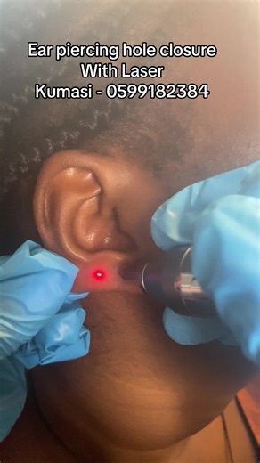 Ear Piercing Hole Closure Options and Techniques