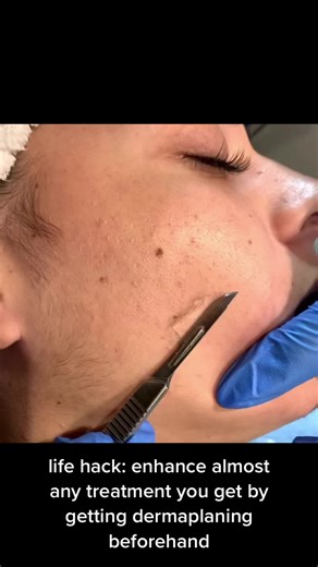 Dermaplaning is a form of manual exfoliation (and my personal favorite) - it removes dead skin & vellus hairs on the face (peach fuzz) making skincare and treatments more effective   it’s great to do before events for FLAWLESS make-up application. #fyp #dermaplaning #facial #esthetician #medspa #dallas #plano