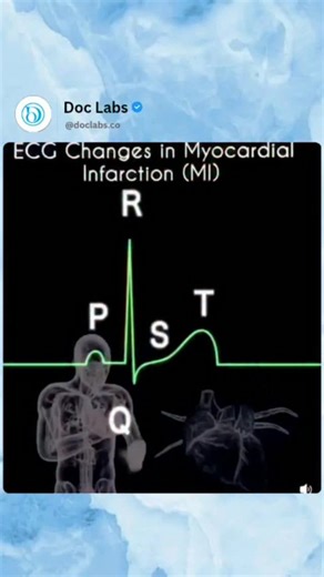 Doc Labs ™ on Instagram: "🔥 MI Evolution on ECG: What Changes From Minutes to Months? Save this — it’s one of the highest-yield cardiology topics! 📌🫀 ⏱️ Hyperacute Phase (Minutes to Hours) • Tall, peaked T waves (especially in precordial leads) • Early ST-segment elevation ⏱️ Acute Phase (First 24 Hours) • Marked ST-segment elevation • Appearance of pathological Q waves • T-wave inversion may start ⏱️ Subacute Phase (Days to Weeks) • ST segments begin to normalize • Deep T-wave inversion beco