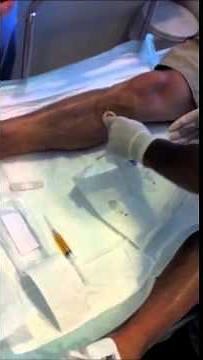 Platelet Rich Plasma and Injection Technique