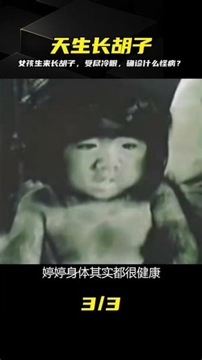 小女孩生下來長滿胡子，長大后更受盡白眼，她是得了什么怪病？ #长胡子，女童，怪病，受冷眼，先天性