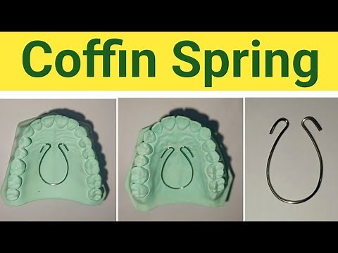 coffin spring | coffin spring orthodontic | coffin spring appliance | fabrication of coffin spring