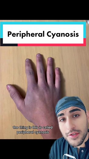 Blue hands #medicine #medicaltiktok #medicalvideo #doctor #medtok #bluehand