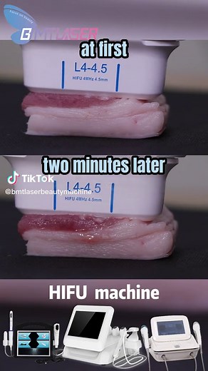 How the HIFU Handle Works#hifu