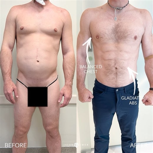 SUPERB GLADIATOR LIPO Our patient is young and fit, but struggled to get his definition where he wanted it to be. We gave him that extra push by giving him the GLADIATOR TREATMENT. We removed fat from problem areas across his body and used that fat to graft back into his shoulders and chest to give them a more athletic build. Nearly five months later, and he’s looking absolutely stunning, with amazing shape to his arms, a carved chest, and gladiator abs to boot. He has been overjoyed by his resu